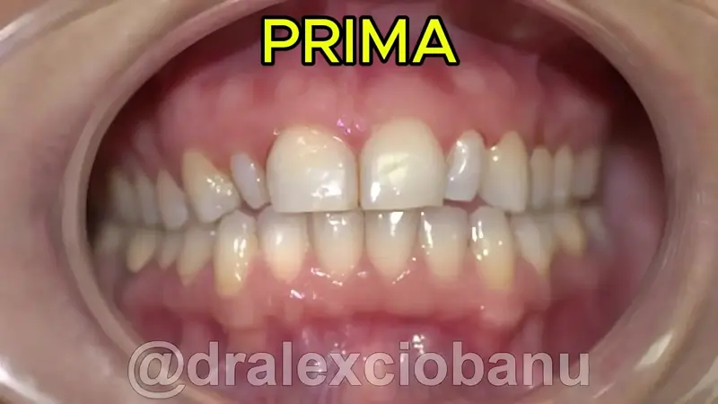 Caso clinico ORTODONZIA LINGUALE INVISIBILE 2D - Prima - Dopo