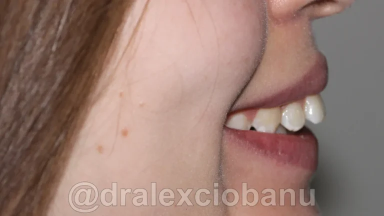 Caso clinico OVERBITE - SOVRAMORSO - 1 Prima 1