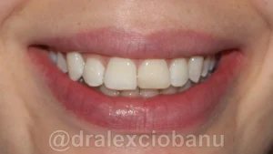 Caso clinico OVERBITE (SOVRAMORSO) dopo