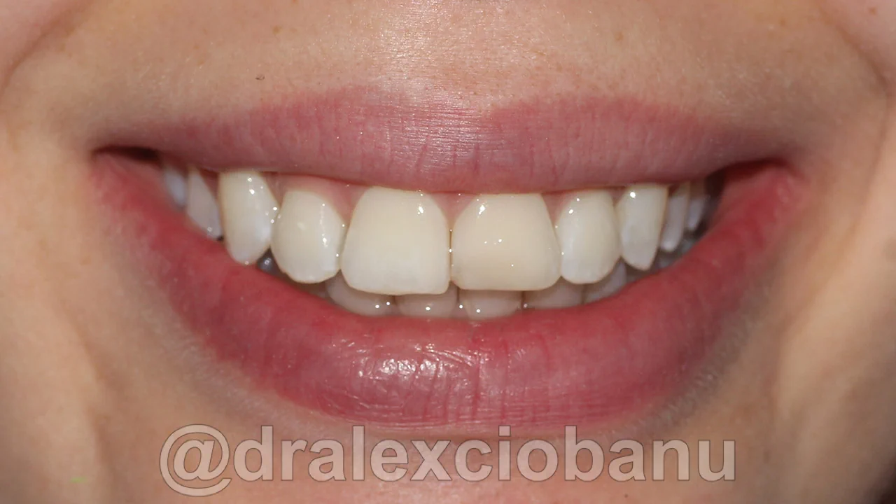 Caso clinico OVERBITE (SOVRAMORSO) dopo