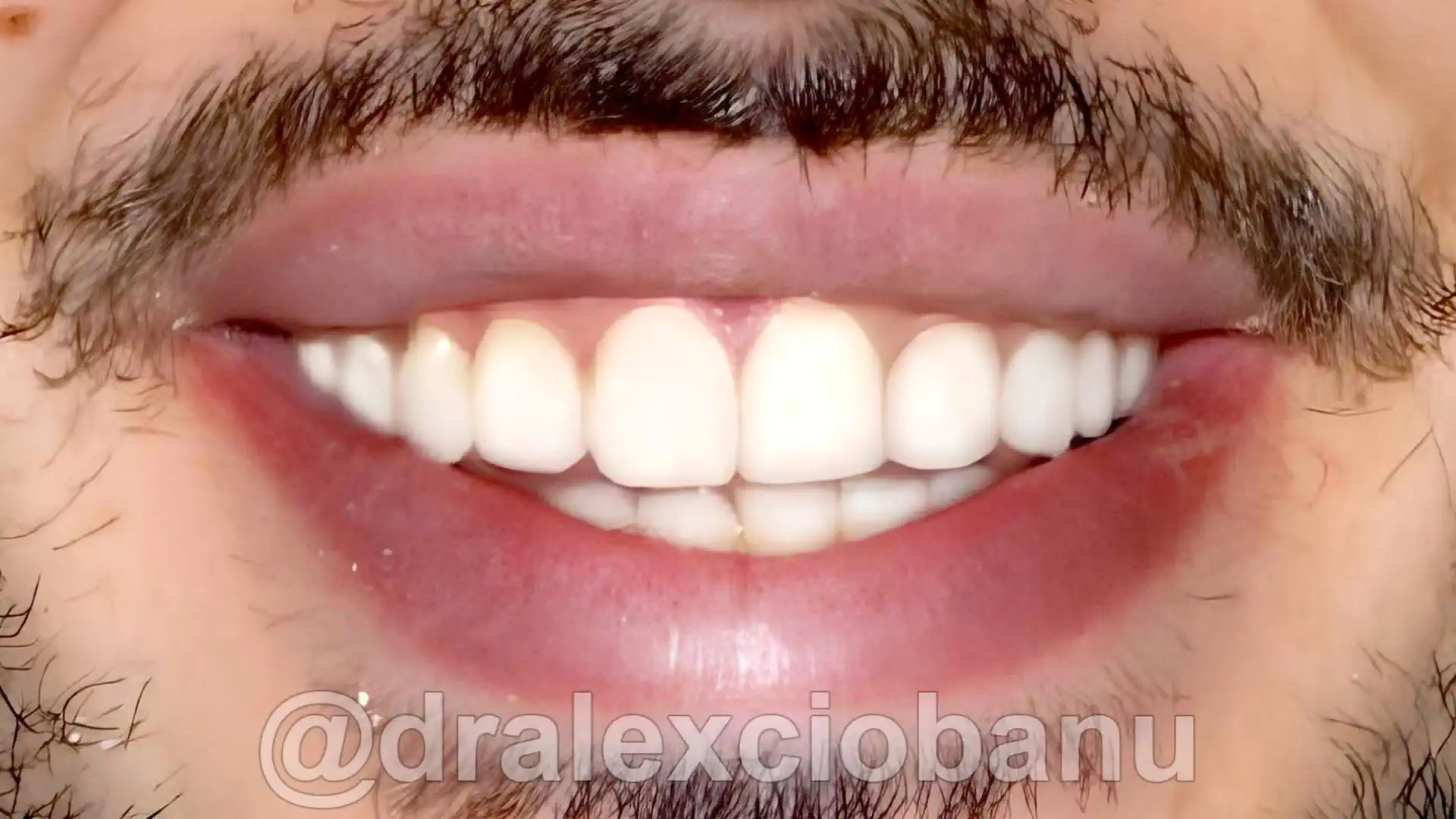 Dopo Correggere gli spazi tra i denti