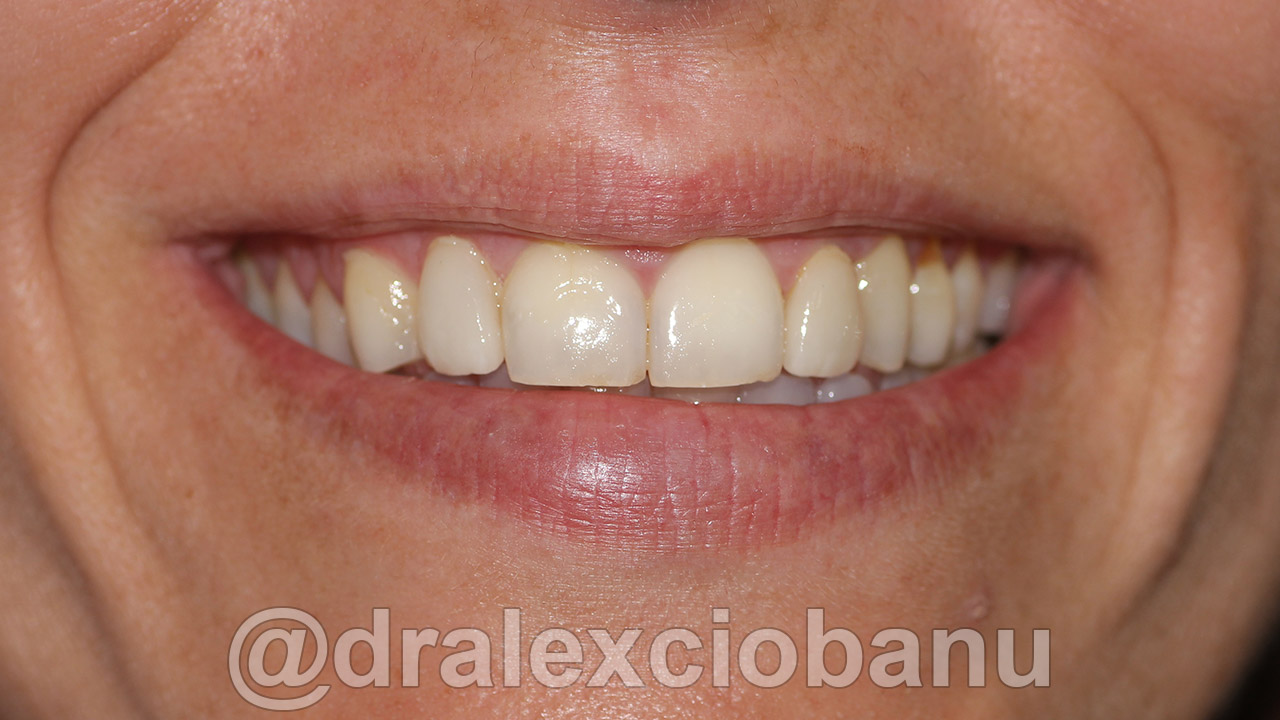 Faccette dentali ceramica e Ortodonzia Linguale Invisibile 2D Soriso