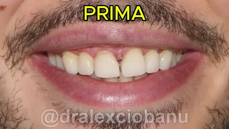 Caso Clinico Correggere Gli Spazi Tra I Denti - Prima - Dopo