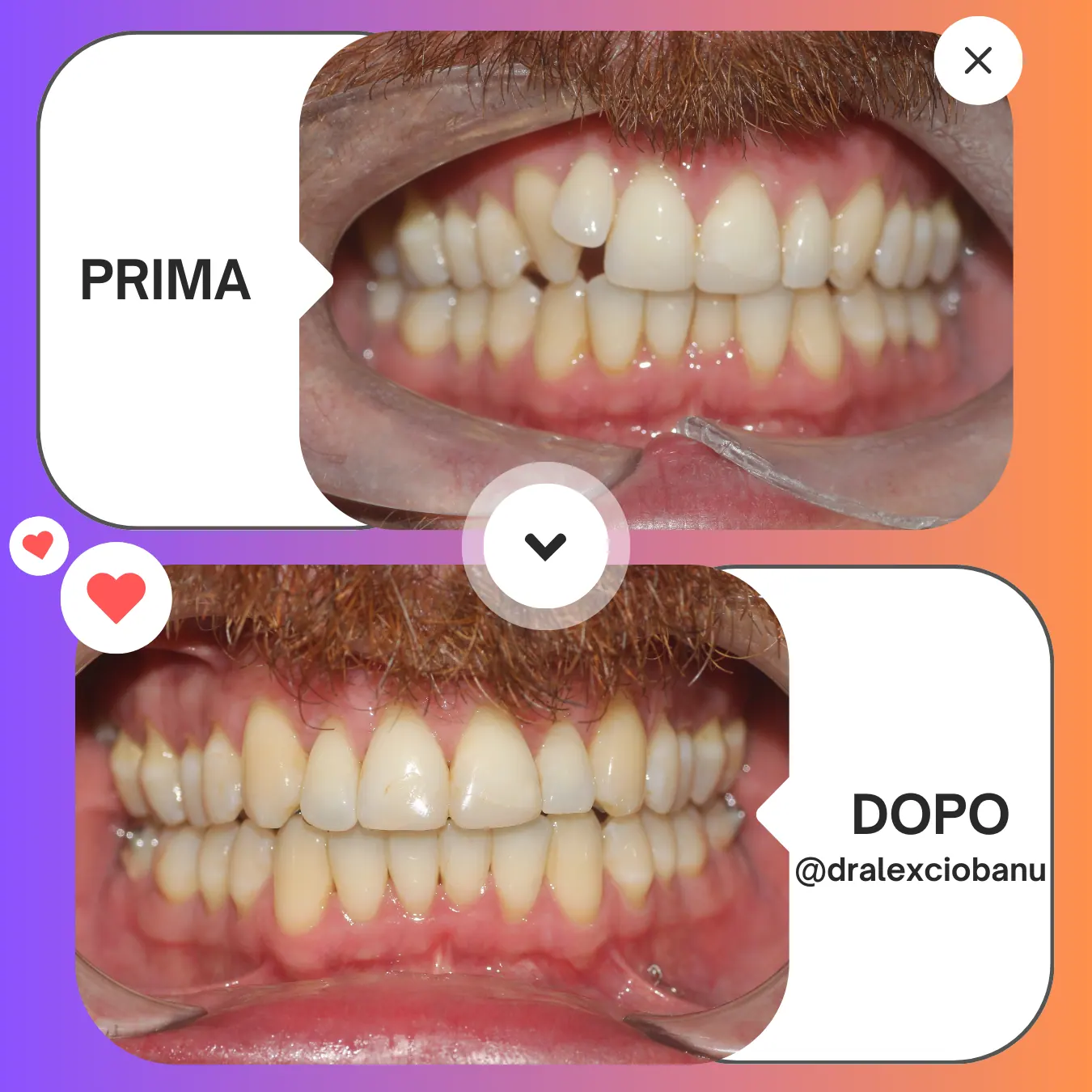 Prima - Dopo affollamento dentale