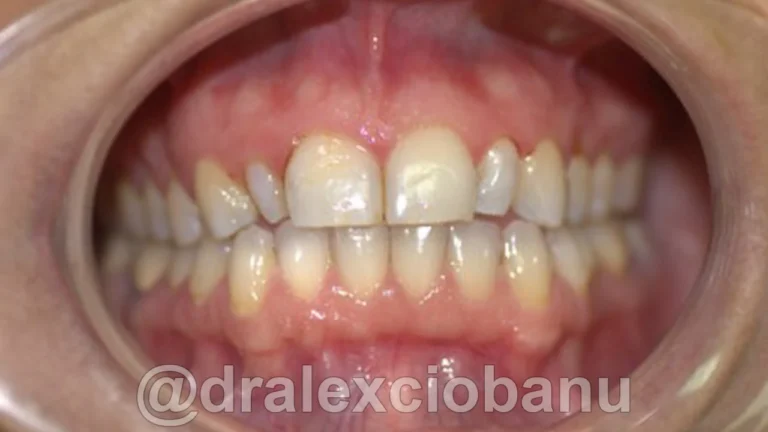 Prima-FACCETTE-DENTALI-CERAMICA-E-ORTODONZIA-LINGUALE-INVISIBILE-2D