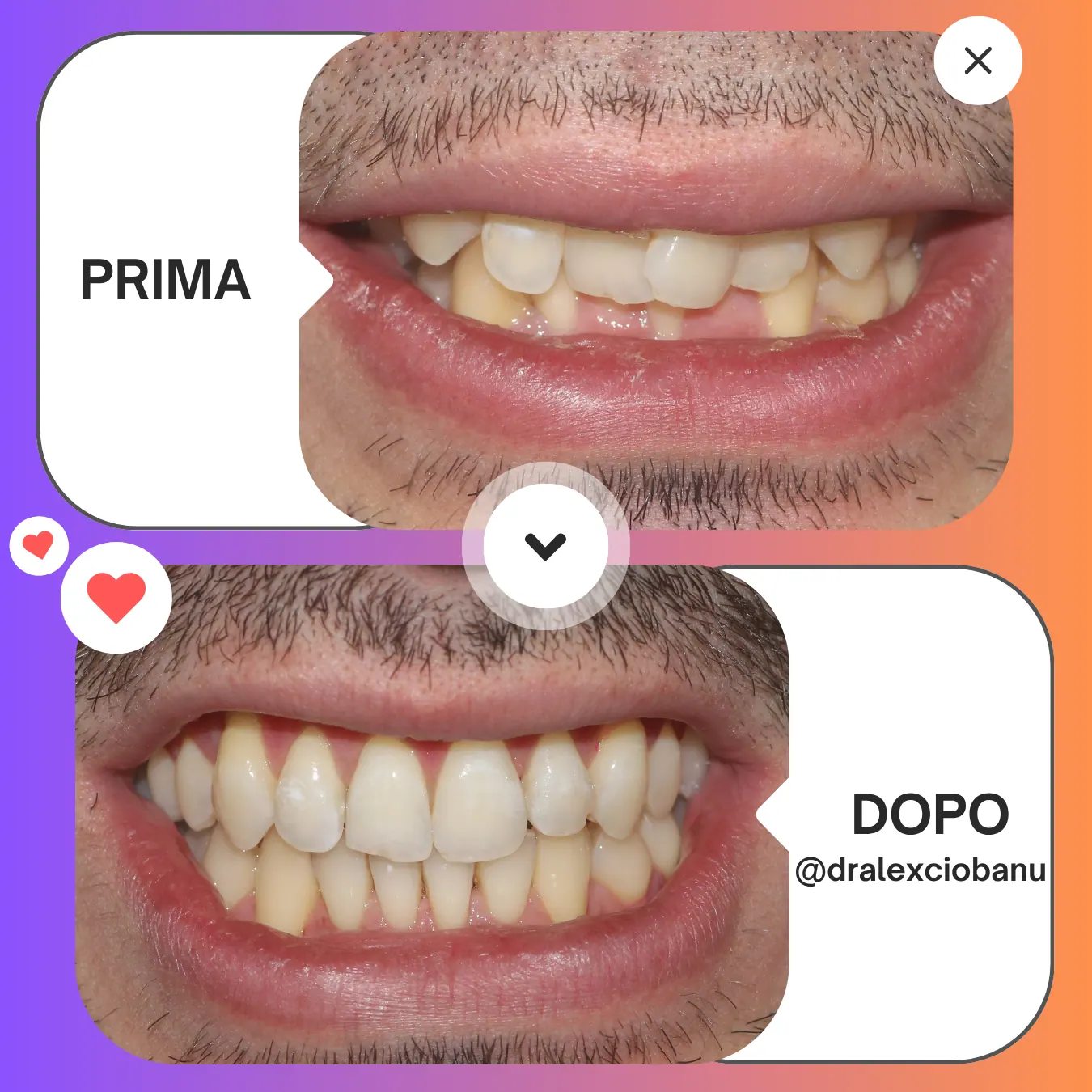 Trattamento con apparecchio linguale WIN